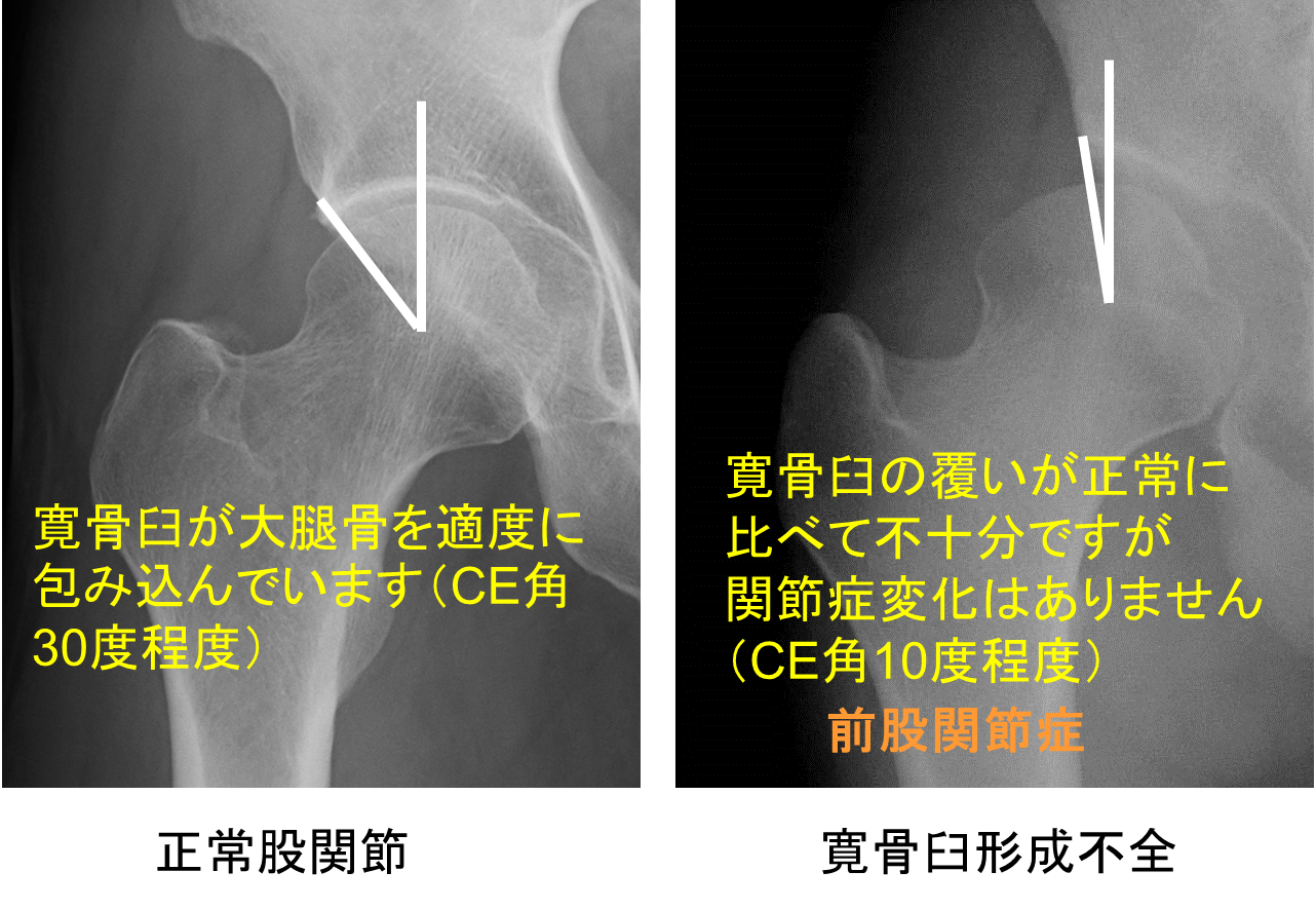 股関節の違和感を放置するとどうなる？寛骨臼形成不全の真実と選択