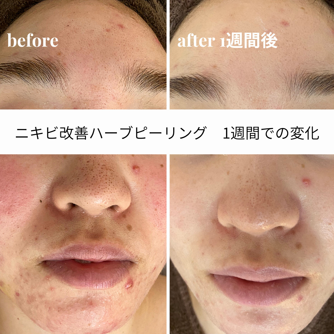 ハーブピーリング失敗の真相！肌荒れ悪化の理由と好転反応の見分け方