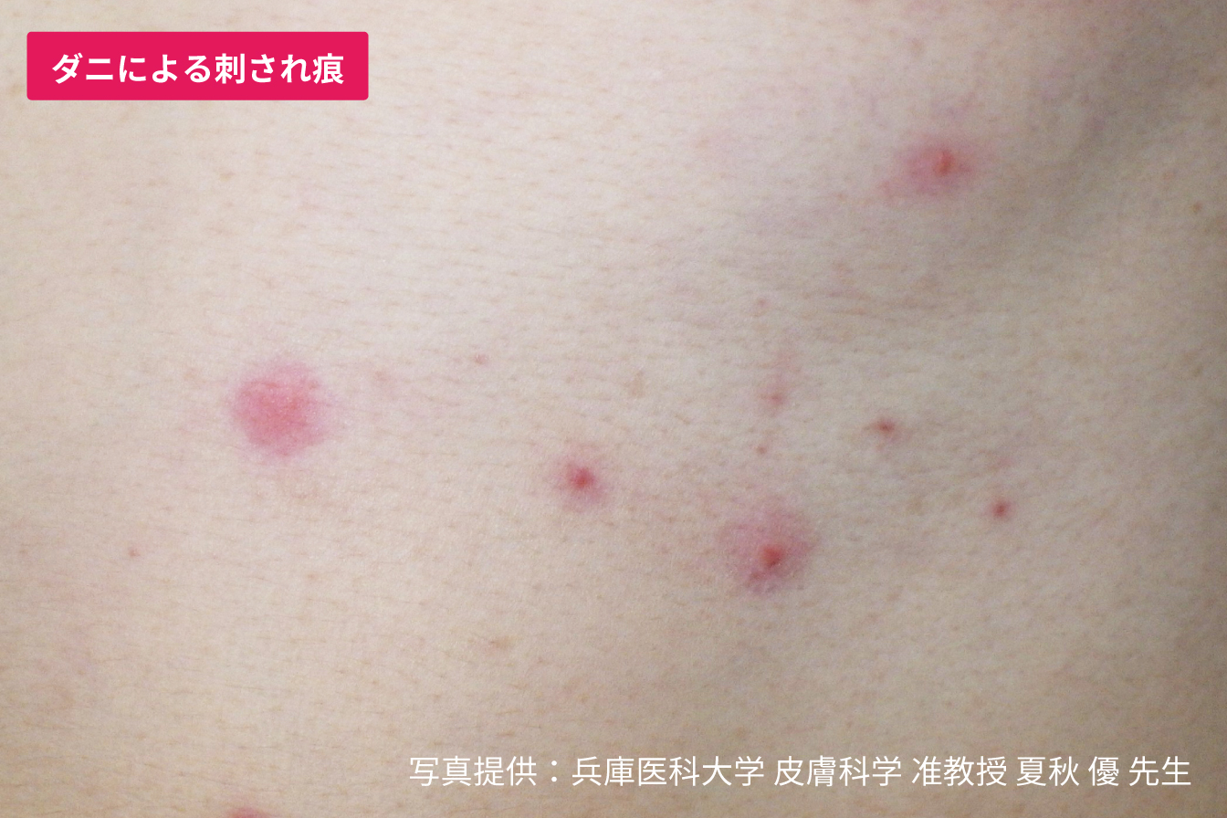 身体のかゆみはダニの仕業？刺され跡の見分け方と2026年最新退治法