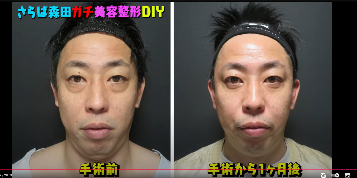 目の下のたるみ整形を公表した芸能人一覧！クマ取りの真相と失敗回避術