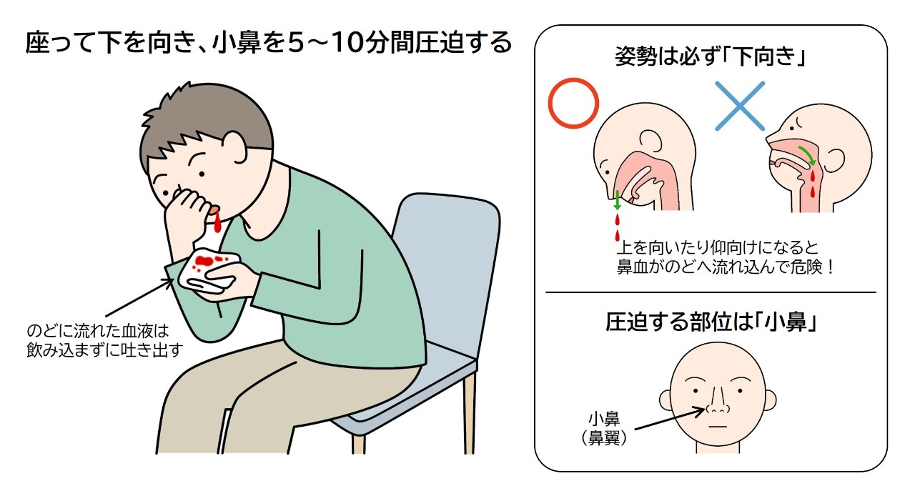 【医師解説】鼻血の正しい止め方！ティッシュNgの理由と緊急止血法