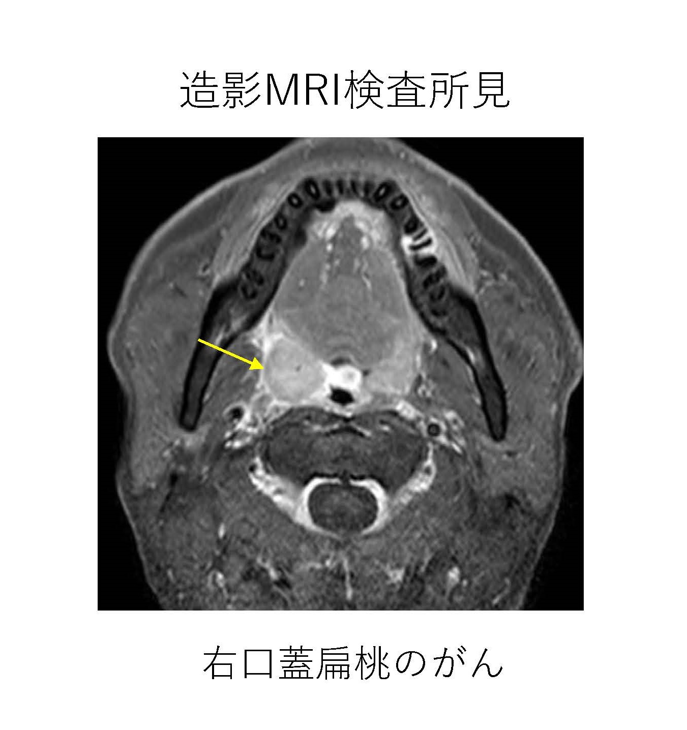 中咽頭がんの初期症状・生存率・最新治療法を徹底解説！喉の違和感を放置してはいけない理由