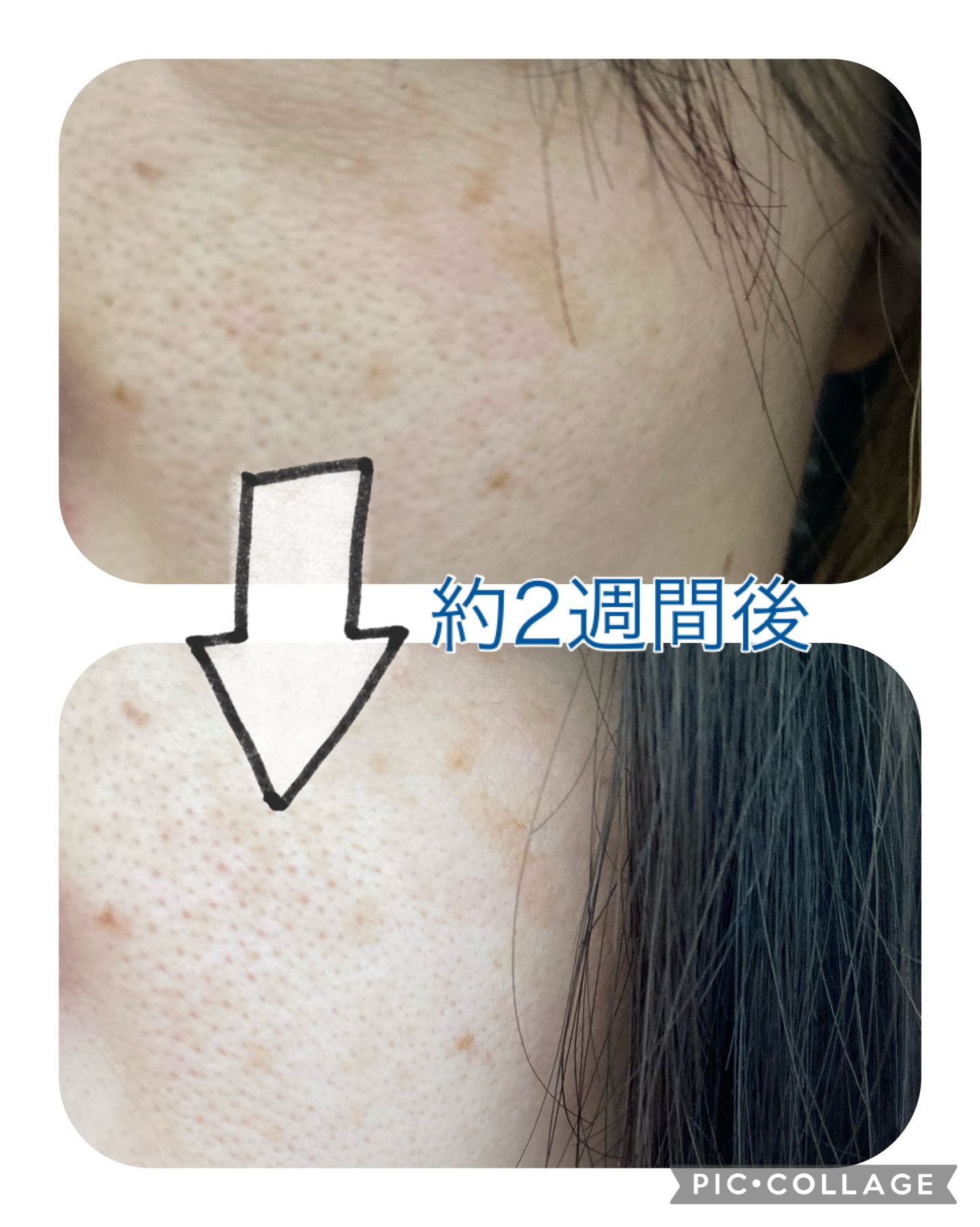 タカミスキンピールの口コミを徹底検証！毛穴や肌荒れ悪化の真相とは