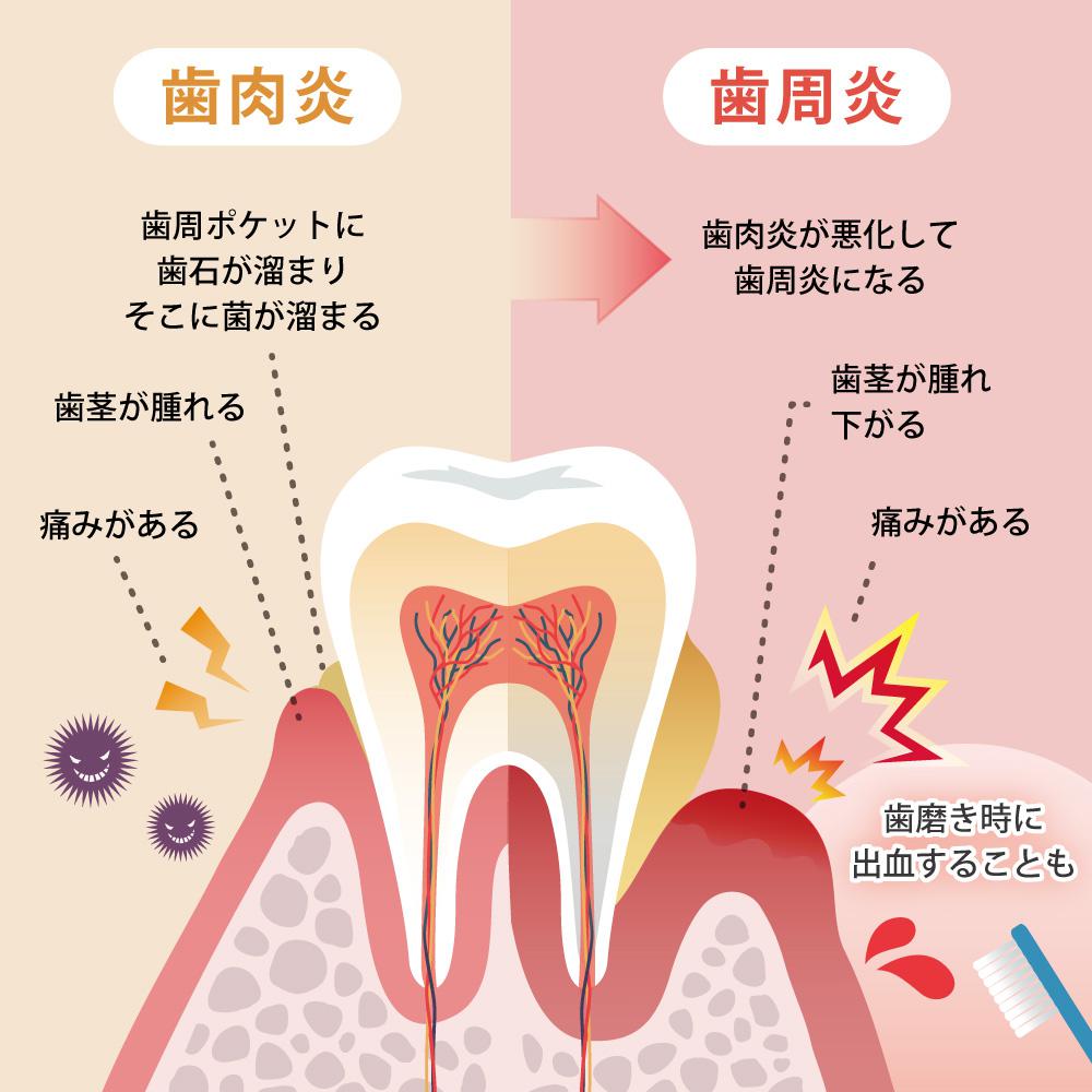 歯茎の出血は危険信号？原因と正しい治し方・受診目安を徹底解説