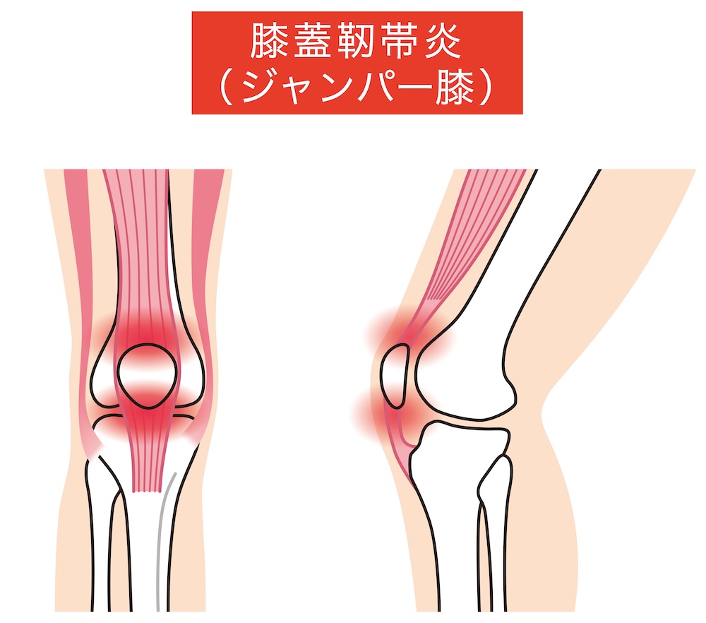 ジャンパー膝とは？治らない原因と重症度ステージ・治し方を徹底解説