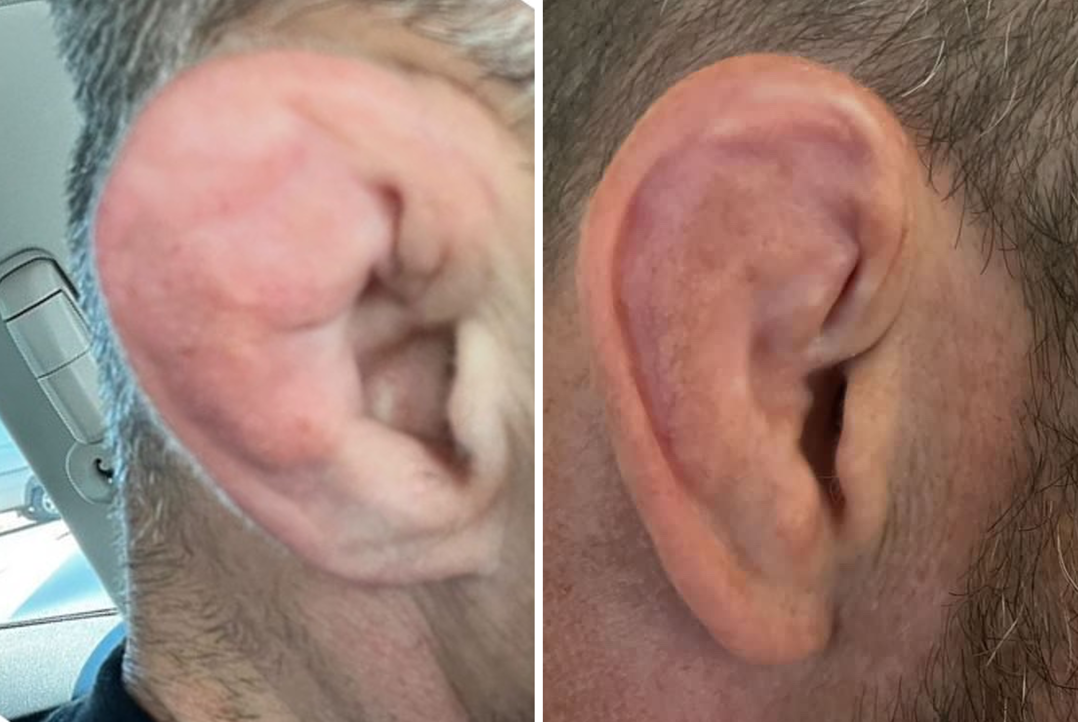 Can You Fix a Cauliflower Ear