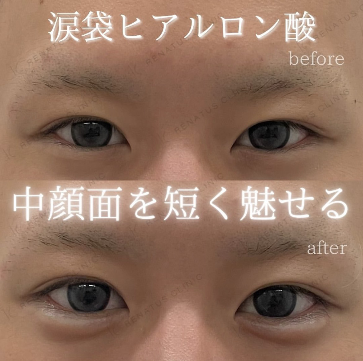 男の涙袋はモテる？気持ち悪い？女子の本音と失敗しない作り方最新検証