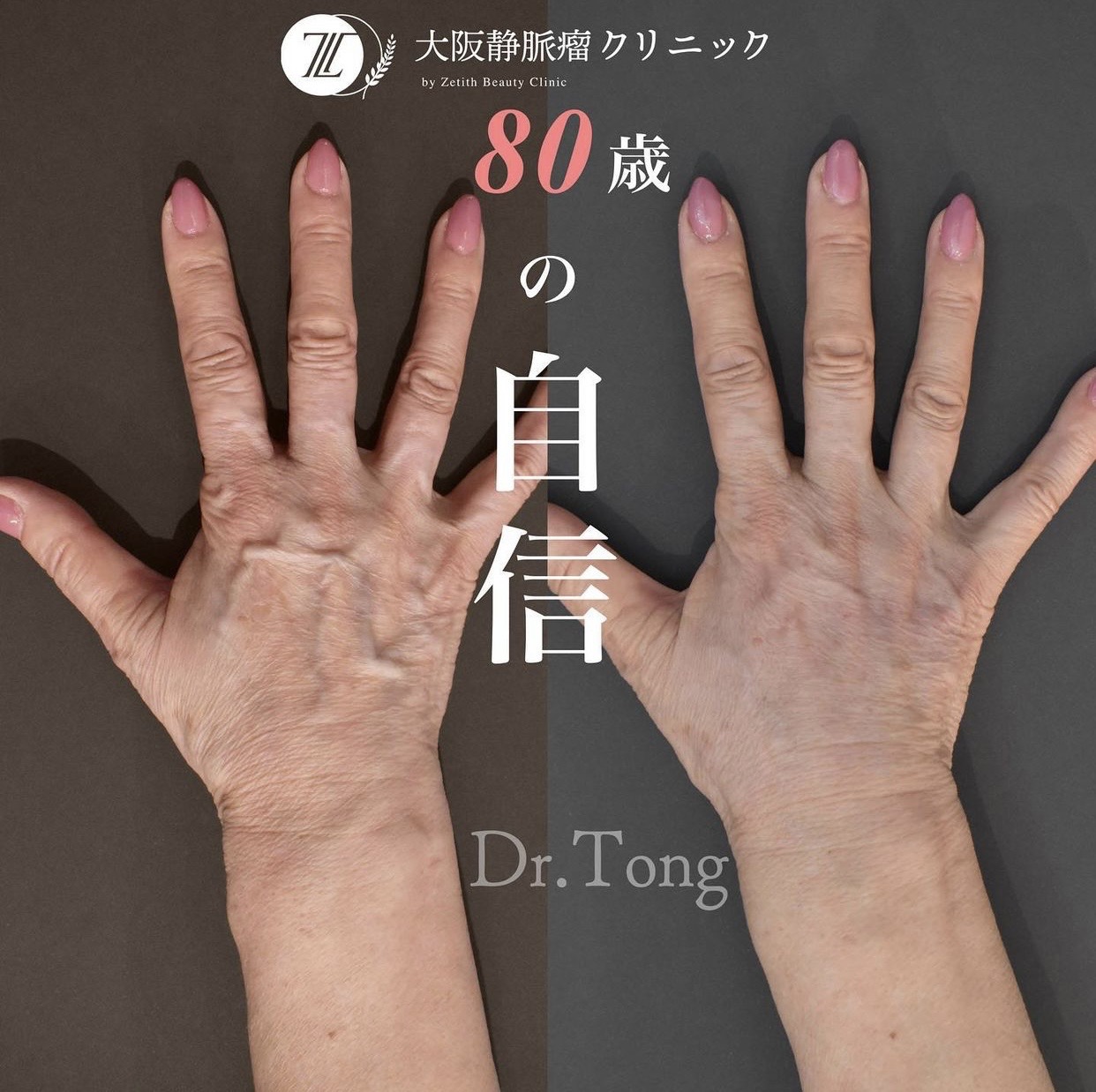 手の血管が浮き出る理由と病気のリスク｜ハンドベイン最新治療と予防策