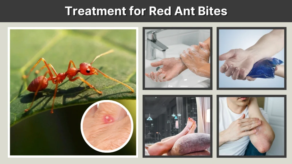 Bitten by Ants Treatment