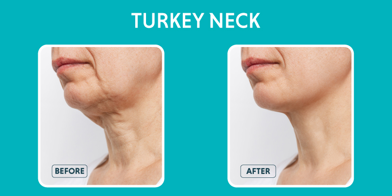 What Is Turkey Neck Called
