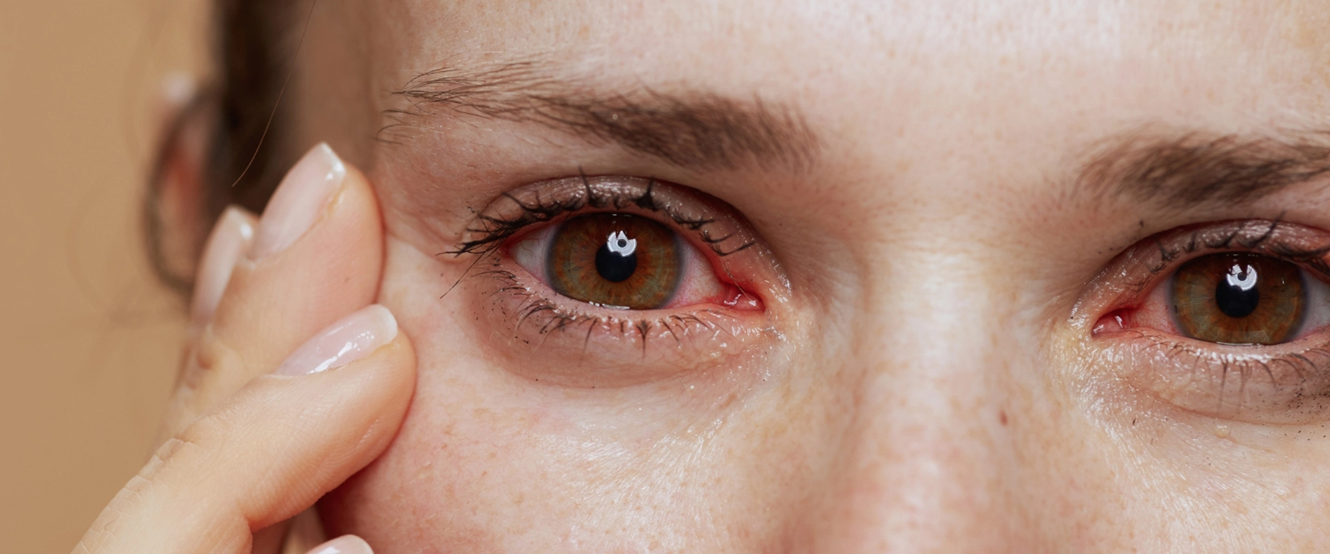 How Long Does Swollen Eyes from Crying Last