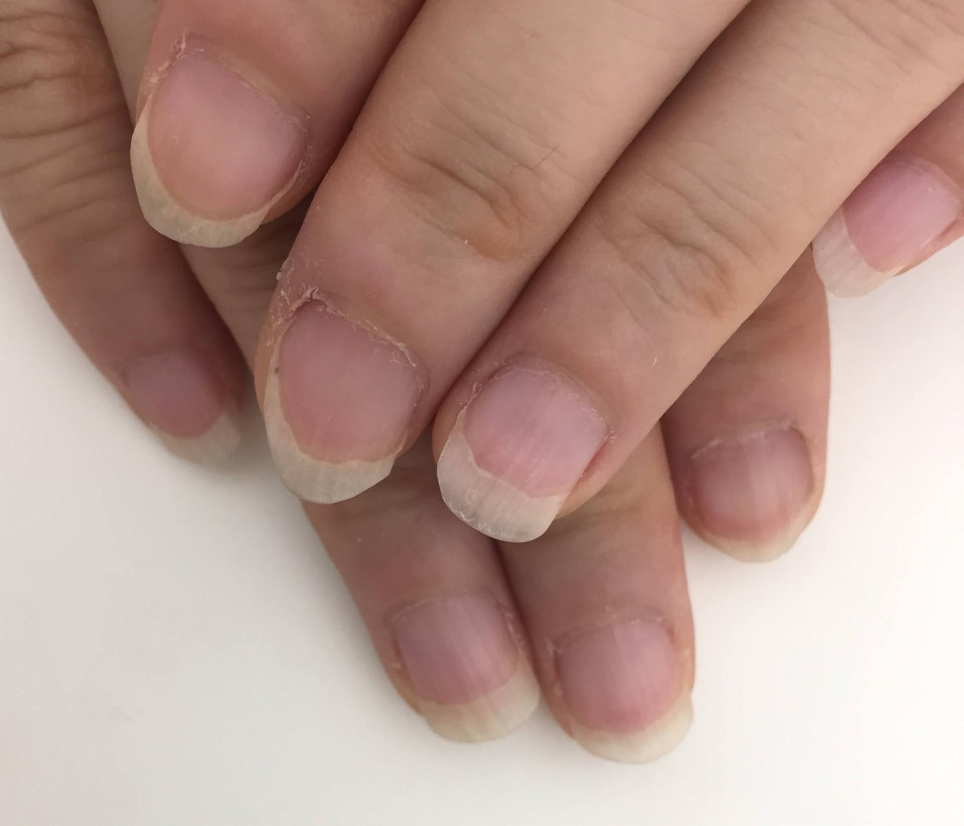 爪の白い部分が多い原因とは？ピンクを伸ばす育爪と病気のサインを徹底解説