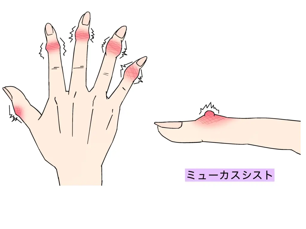指の第一関節が痛い原因とは？更年期に急増する病気と最新の治し方