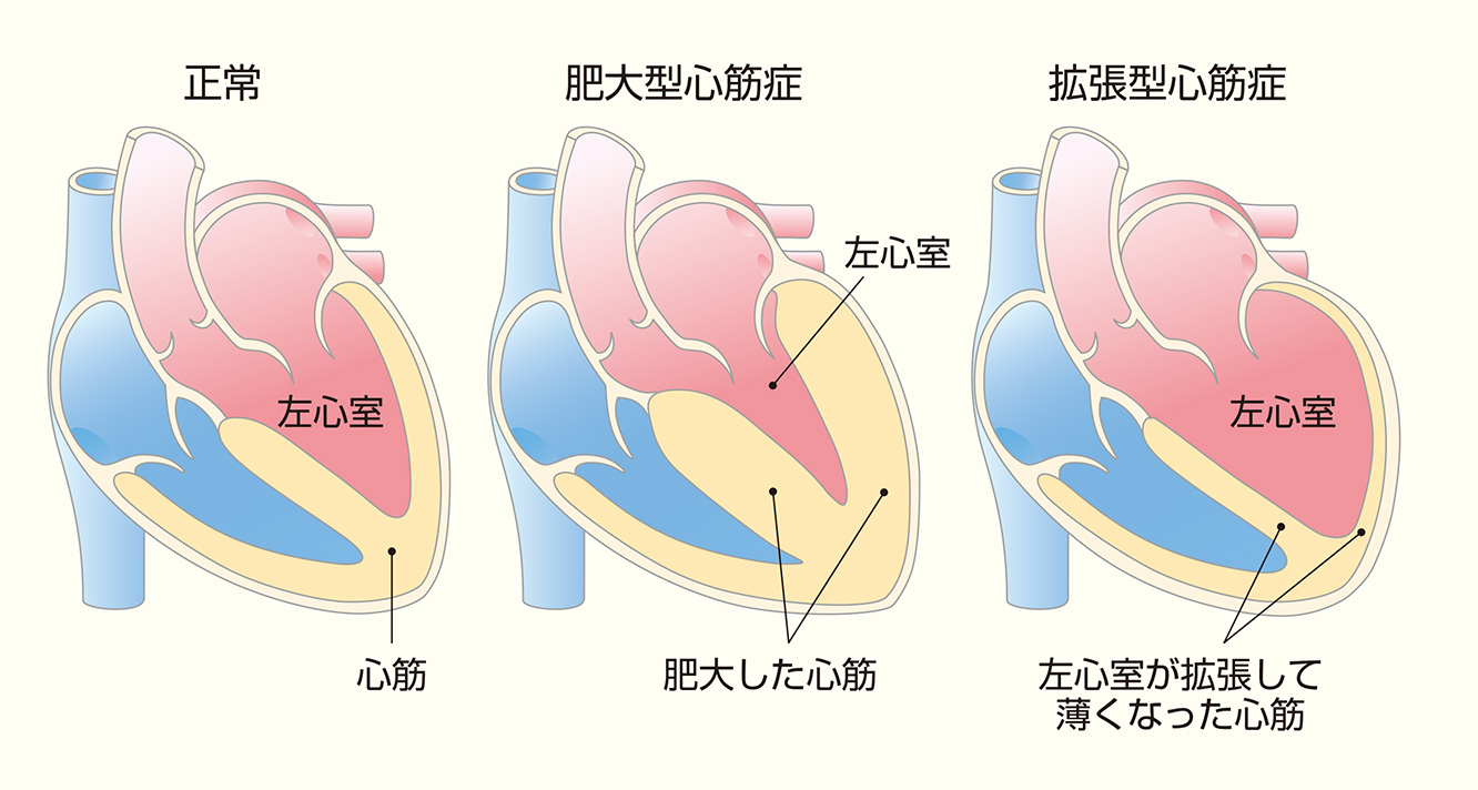 高齢者の心臓肥大は放置厳禁！寿命への影響と初期症状・最新治療解説