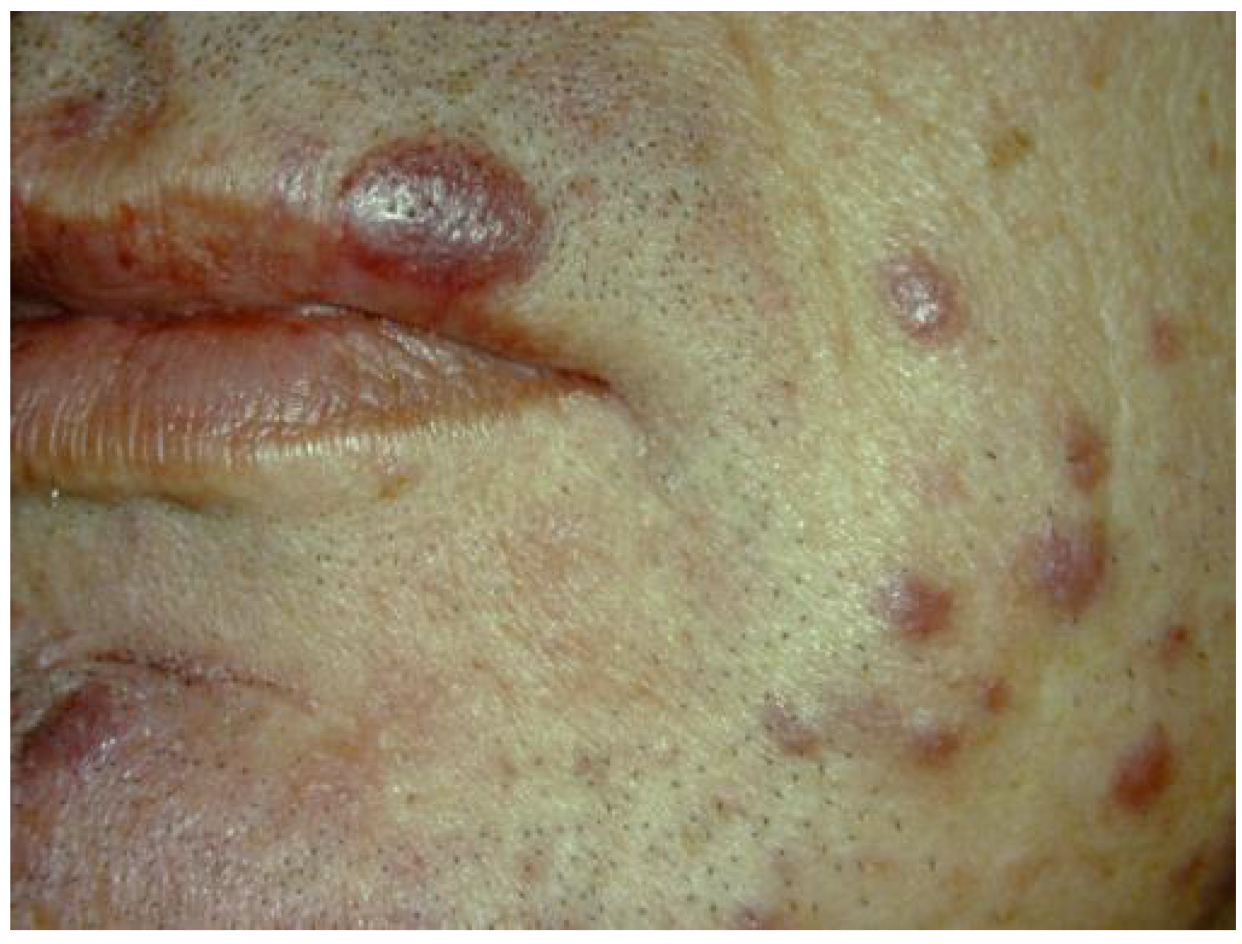 Hiv Lesions Face