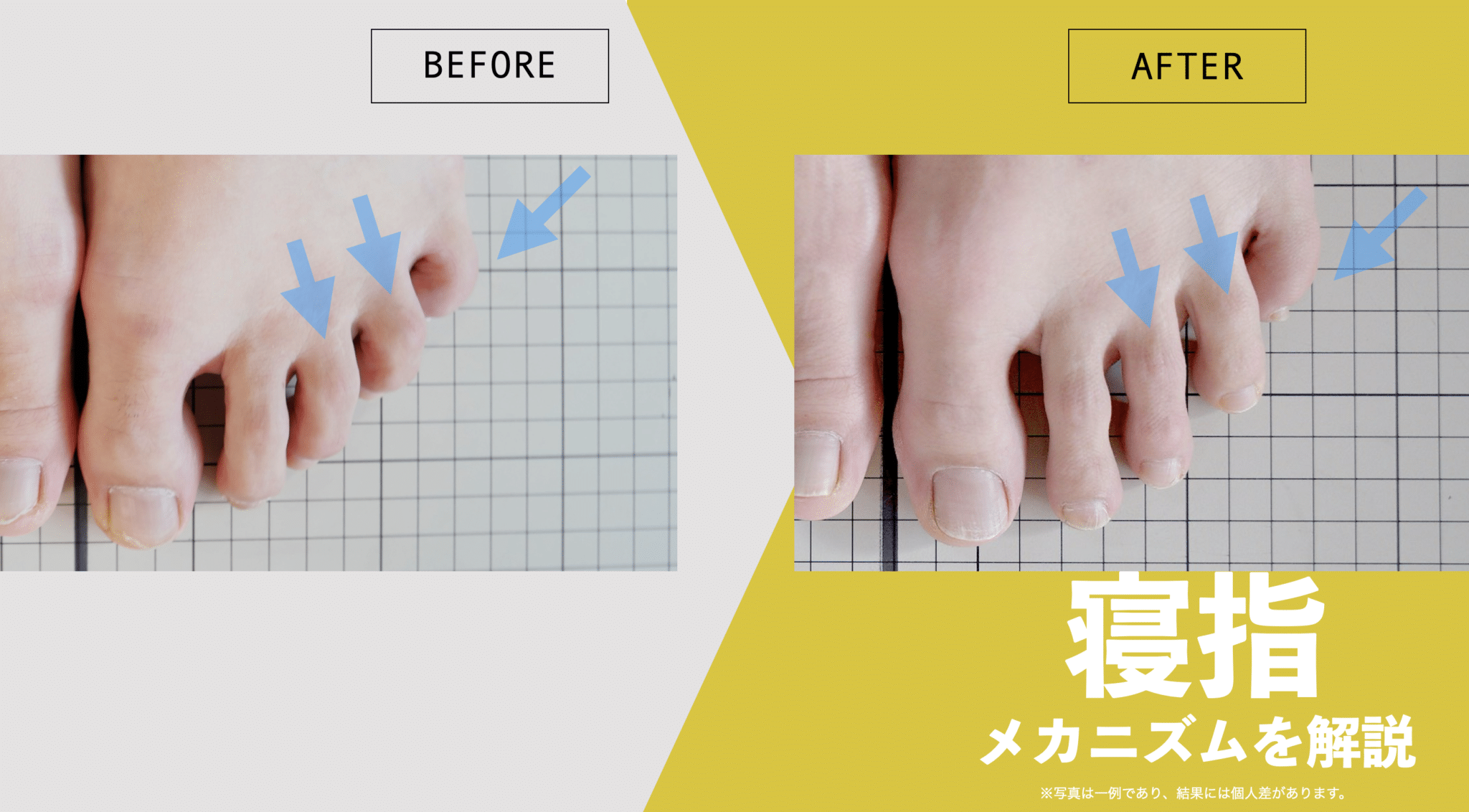 足の小指が倒れる寝指の治し方｜原因究明と改善ケアを徹底解説