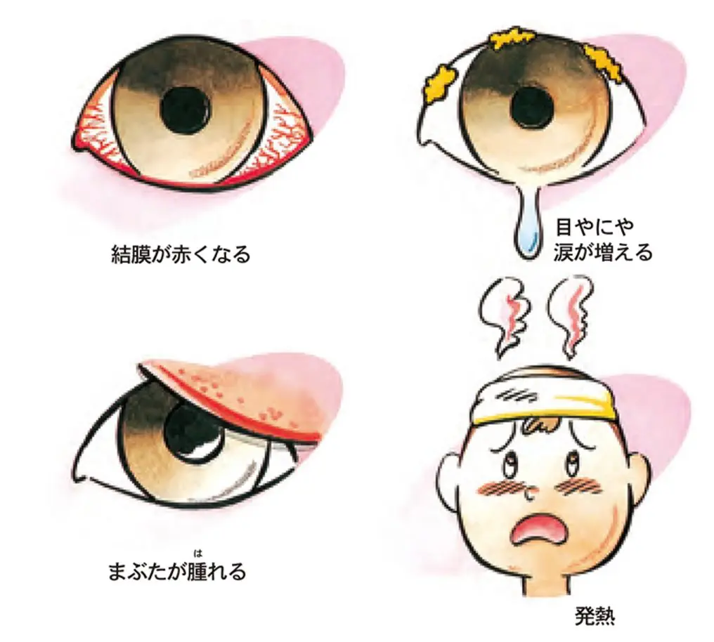 はやり目の初期症状と結膜炎の違い｜感染期間や出勤停止基準を徹底解説