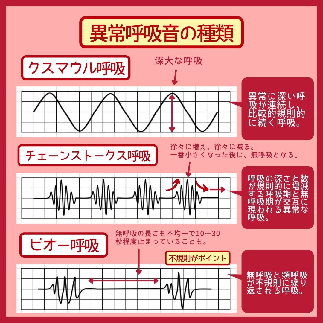 ビオー呼吸とチェーンストークス呼吸の違い｜波形と障害部位の徹底鑑別