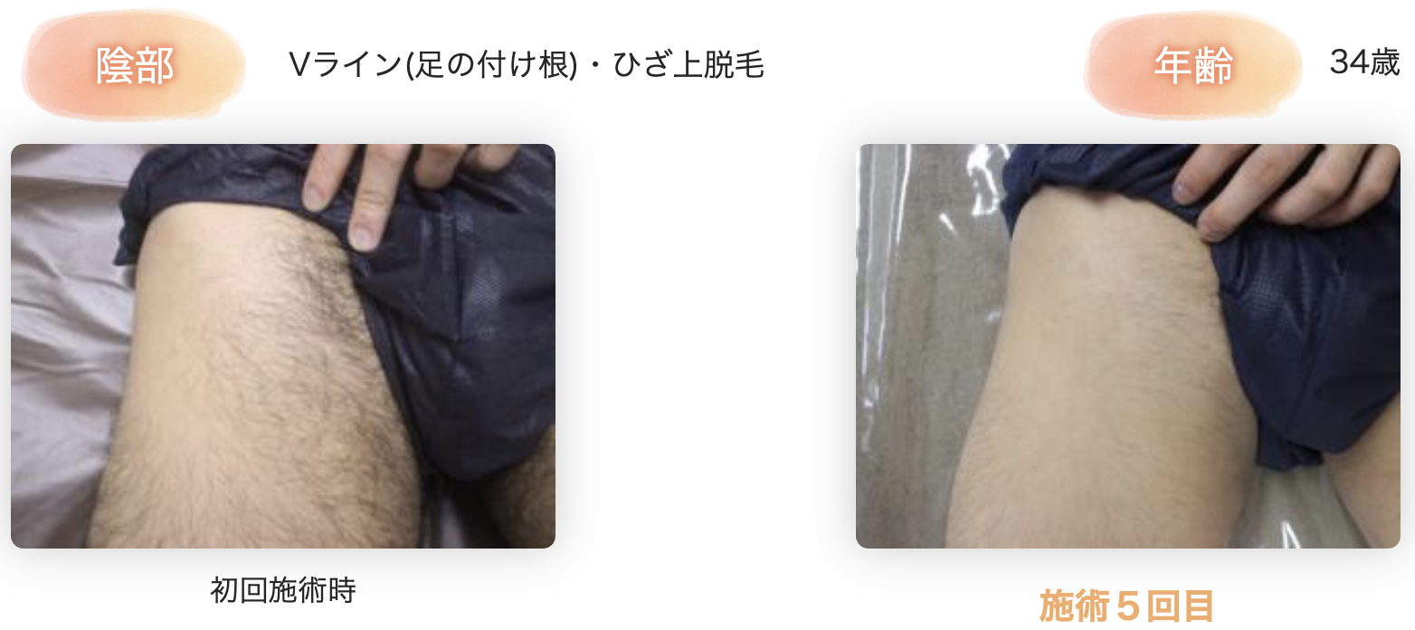 男のチン毛整え方決定版！チクチクしない理想の長さと処理手順