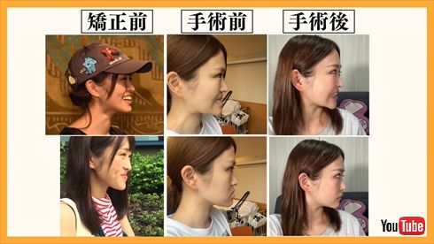 【真相】 顎 変形 症 芸能人 Tiktok話題の動画 #800