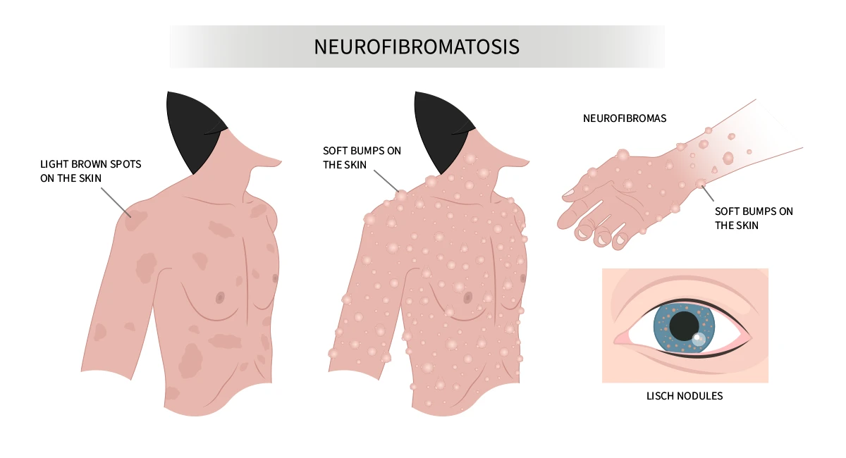 Symptoms of Neurofibromatosis Type 2