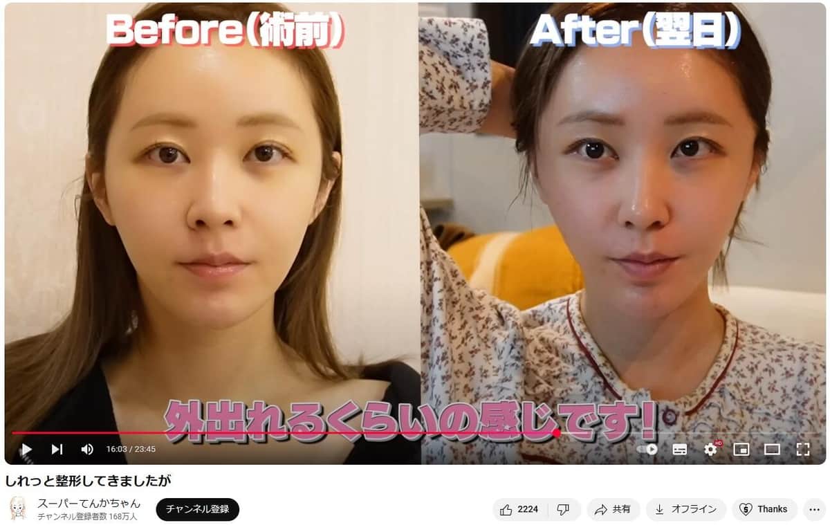 てんちむ整形前の真実と劇的変化！告白した施術と現在までの全記録