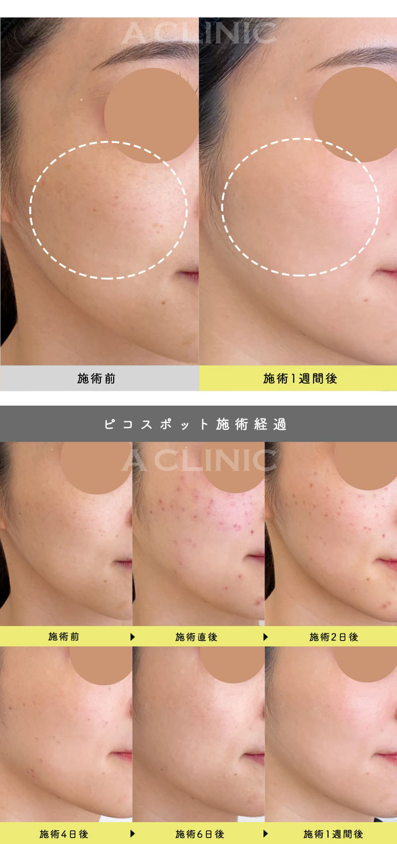 ピコレーザーとは？効果と従来機との違い・失敗しない選び方を徹底解説