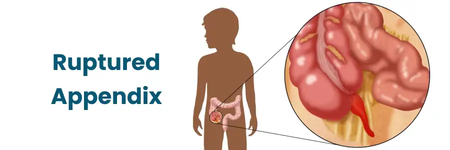 Ruptured Appendix Icd 10